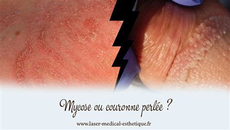 papule perlée|Tout savoir sur la couronne perlée du gland